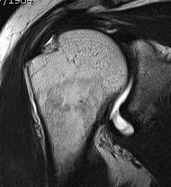 Shoulder MRI Footprint Exposure Supraspinatous Articular Tear